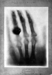 Early x-ray of a hand taken by Wilhelm Roentgen