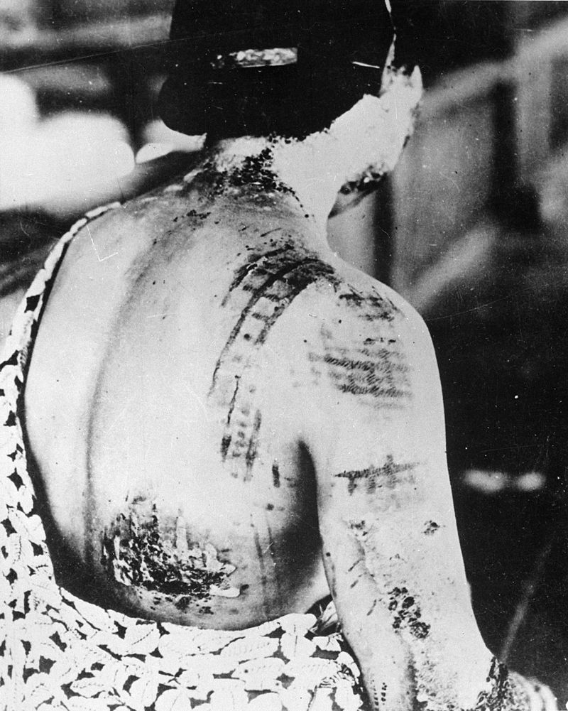 A survivor's skin burned in the pattern of her kimono